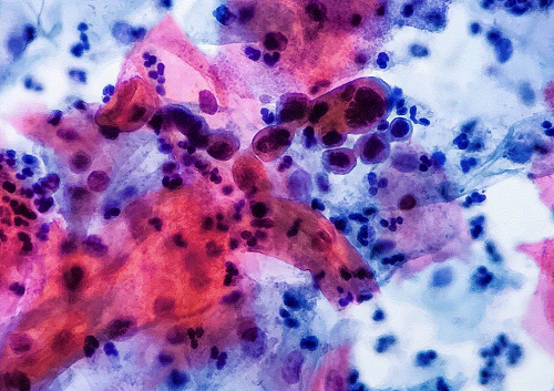 Citologías vaginales y serotipificación de HPV